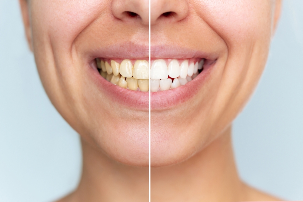 teeth whitening El Paso