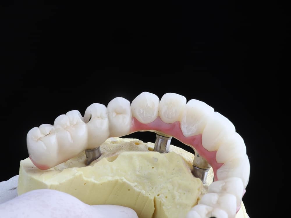all-on-4 implants El Paso